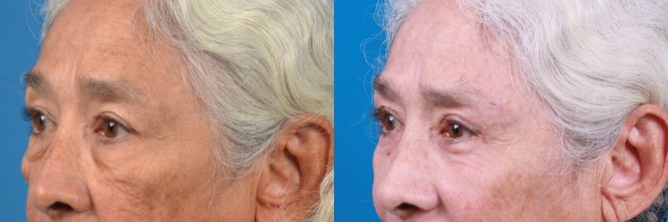 Eyelid Surgery Before & After Gallery - Patient 122444776 - Image 1