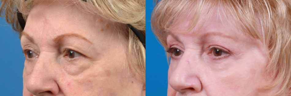Eyelid Surgery Before & After Gallery - Patient 130672 - Image 1