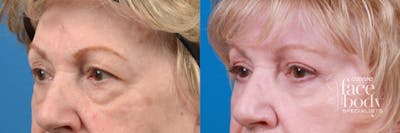 Eyelid Surgery Before & After Gallery - Patient 130672 - Image 1