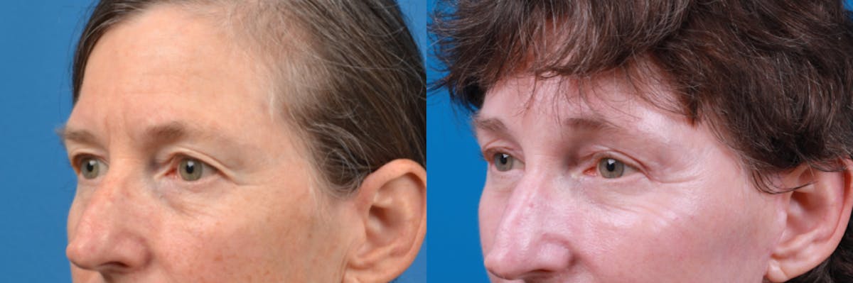 Eyelid Surgery Before & After Gallery - Patient 122444779 - Image 1