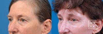 Eyelid Surgery Before & After Gallery - Patient 308942 - Image 1