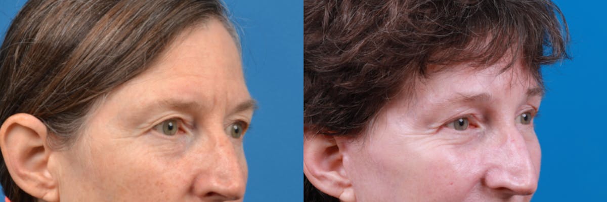 Eyelid Surgery Before & After Gallery - Patient 122444779 - Image 3