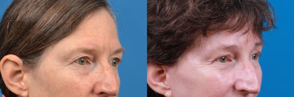 Eyelid Surgery Before & After Gallery - Patient 122444779 - Image 3