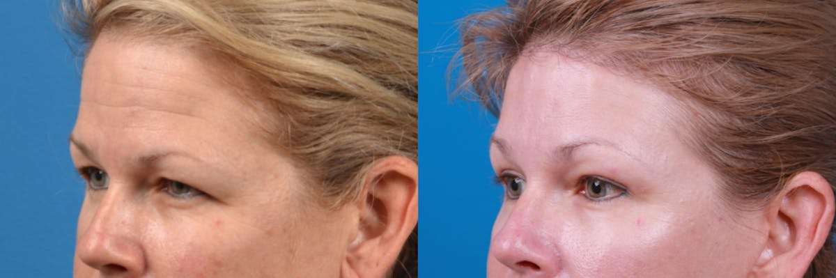 Eyelid Surgery Before & After Gallery - Patient 122444782 - Image 1