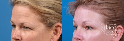 Eyelid Surgery Before & After Gallery - Patient 357905 - Image 1