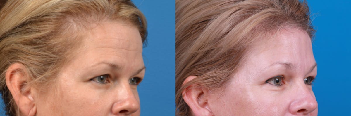 Eyelid Surgery Before & After Gallery - Patient 122444782 - Image 3
