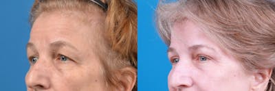 Eyelid Surgery Before & After Gallery - Patient 122444784 - Image 1