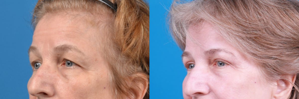 Eyelid Surgery Before & After Gallery - Patient 122444784 - Image 1
