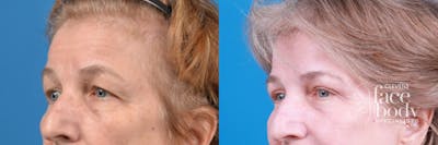 Eyelid Surgery Before & After Gallery - Patient 298974 - Image 1