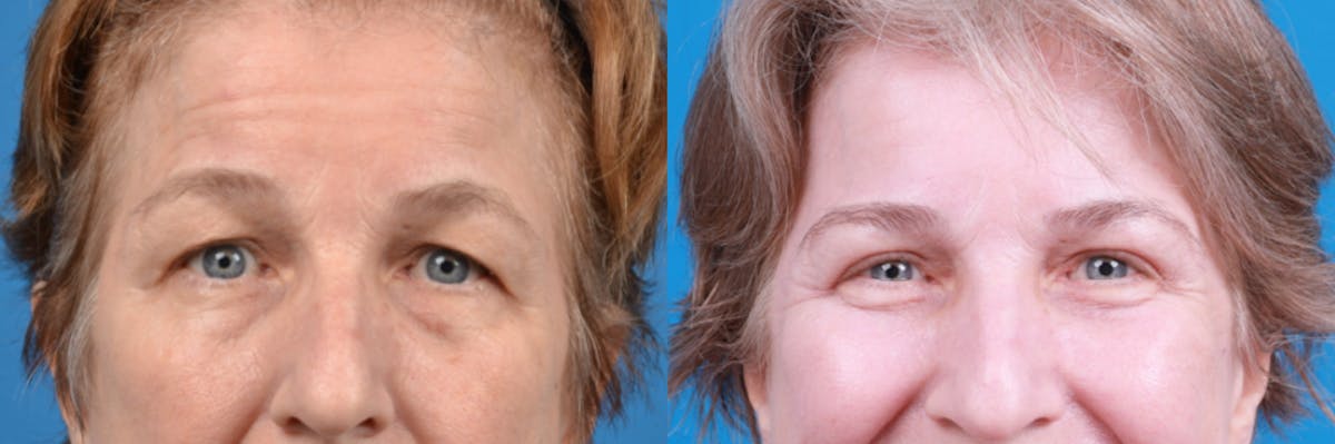 Eyelid Surgery Before & After Gallery - Patient 122444784 - Image 2
