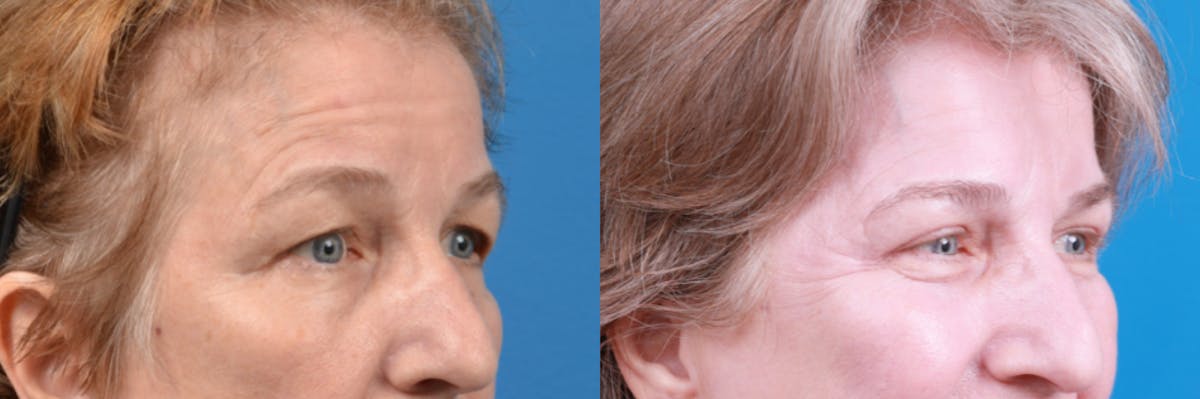 Eyelid Surgery Before & After Gallery - Patient 122444784 - Image 3