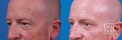Eyelid Surgery Before & After Gallery - Patient 400943 - Image 1