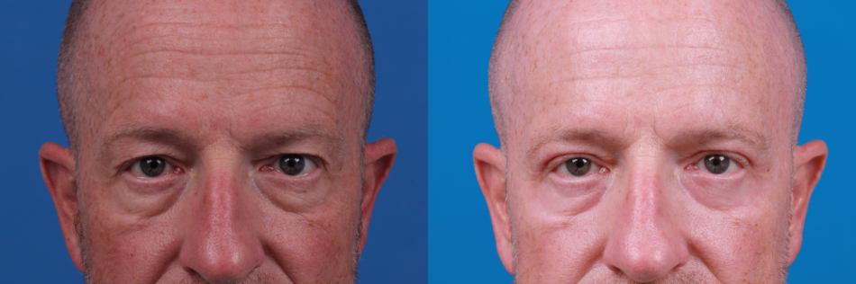 Eyelid Surgery Before & After Gallery - Patient 400943 - Image 2