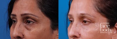 Eyelid Surgery Before & After Gallery - Patient 175540 - Image 1