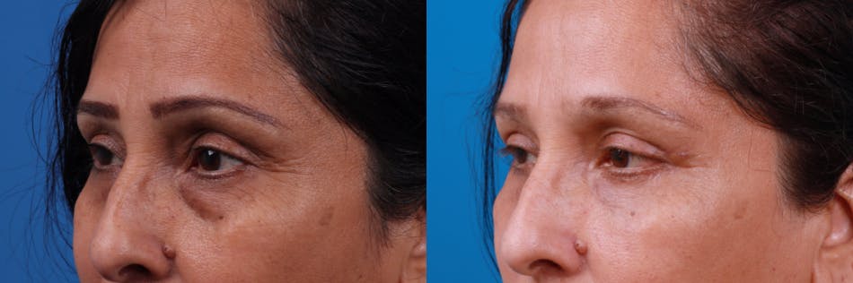 Eyelid Surgery Before & After Gallery - Patient 122444797 - Image 1