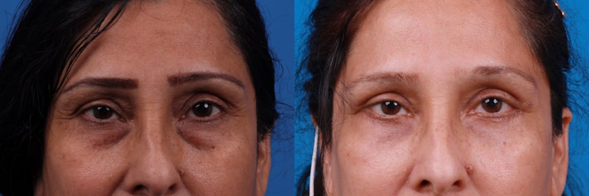 Eyelid Surgery Before & After Gallery - Patient 122444797 - Image 2