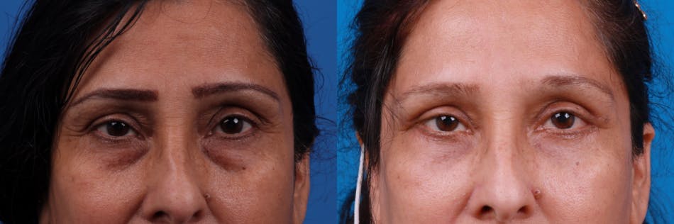 Eyelid Surgery Before & After Gallery - Patient 122444797 - Image 2