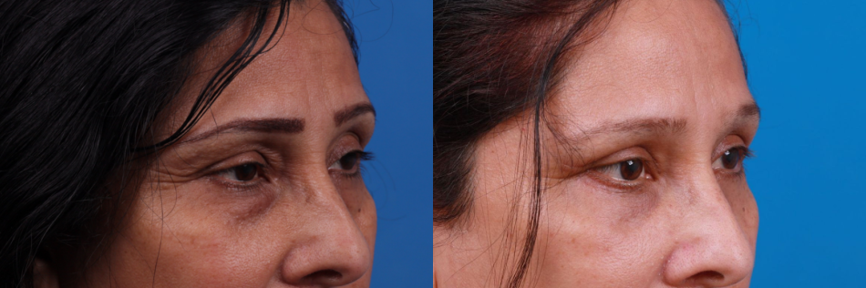 Eyelid Surgery Before & After Gallery - Patient 175540 - Image 3