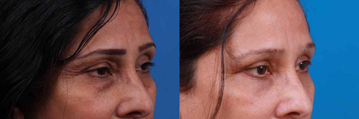 Eyelid Surgery Before & After Gallery - Patient 122444797 - Image 3