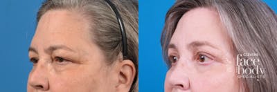 Eyelid Surgery Before & After Gallery - Patient 100598 - Image 1