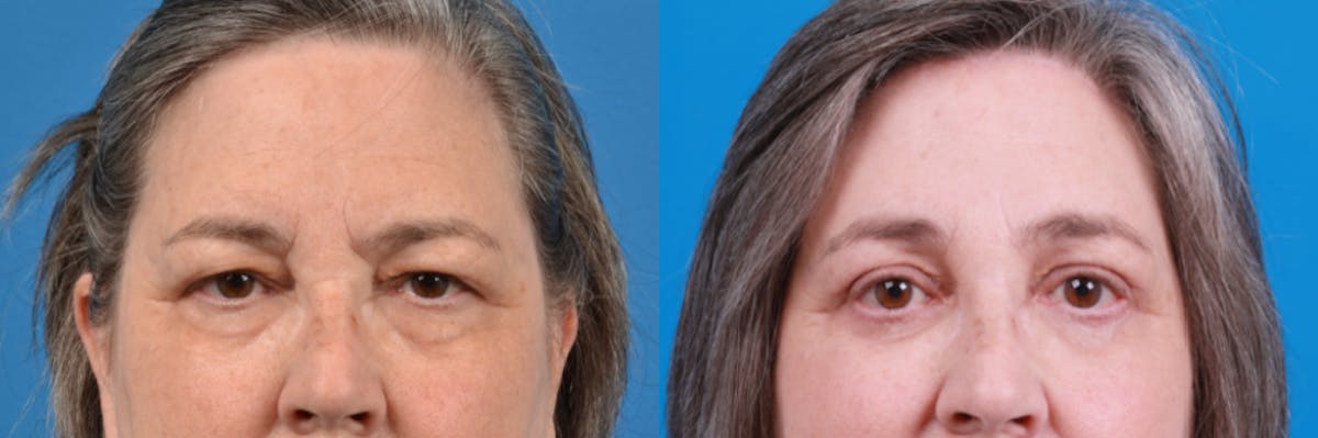 Eyelid Surgery Before & After Gallery - Patient 122444807 - Image 2