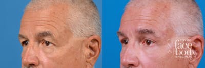 Eyelid Surgery Before & After Gallery - Patient 404125 - Image 1