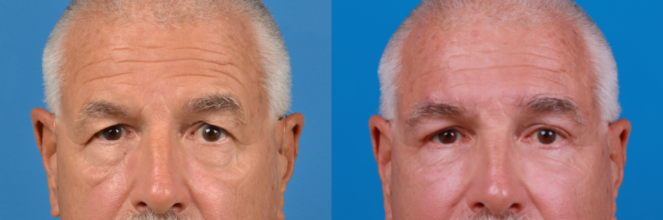 Eyelid Surgery Before & After Gallery - Patient 404125 - Image 2