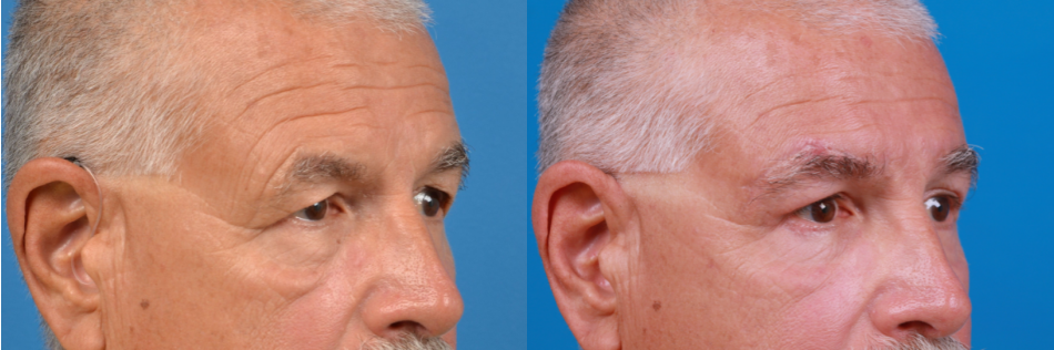 Eyelid Surgery Before & After Gallery - Patient 404125 - Image 3