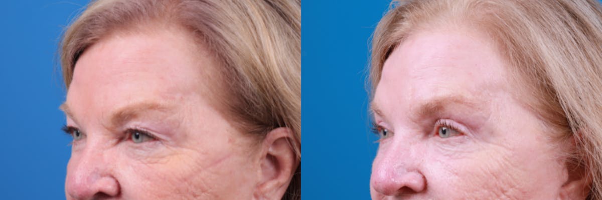 Eyelid Surgery Before & After Gallery - Patient 122444812 - Image 1