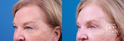 Eyelid Surgery Before & After Gallery - Patient 594356 - Image 1