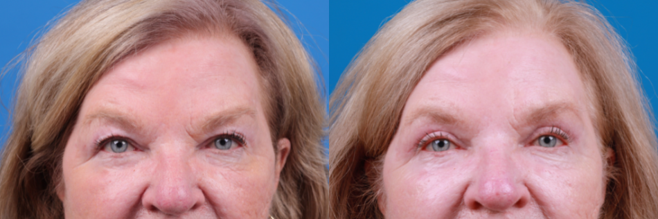 Eyelid Surgery Before & After Gallery - Patient 594356 - Image 2
