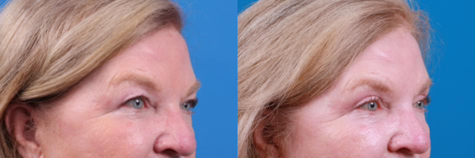 Eyelid Surgery Before & After Gallery - Patient 594356 - Image 3