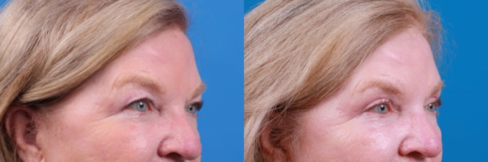 Eyelid Surgery Before & After Gallery - Patient 122444812 - Image 3