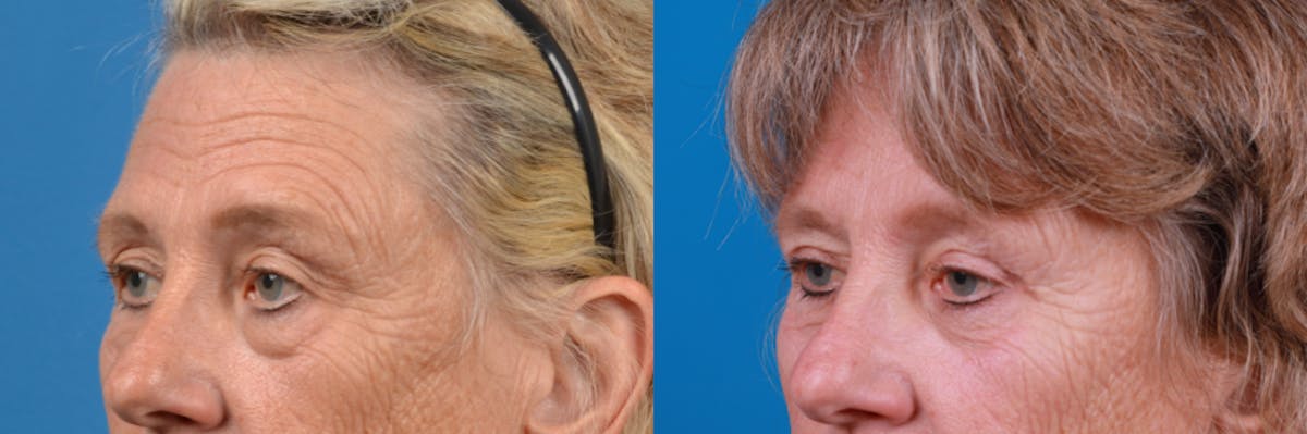 Eyelid Surgery Before & After Gallery - Patient 122444813 - Image 1