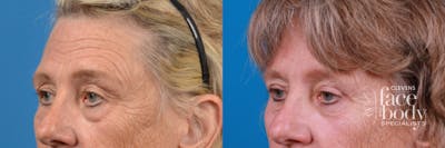 Eyelid Surgery Before & After Gallery - Patient 224476 - Image 1