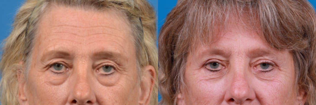 Eyelid Surgery Before & After Gallery - Patient 122444813 - Image 2