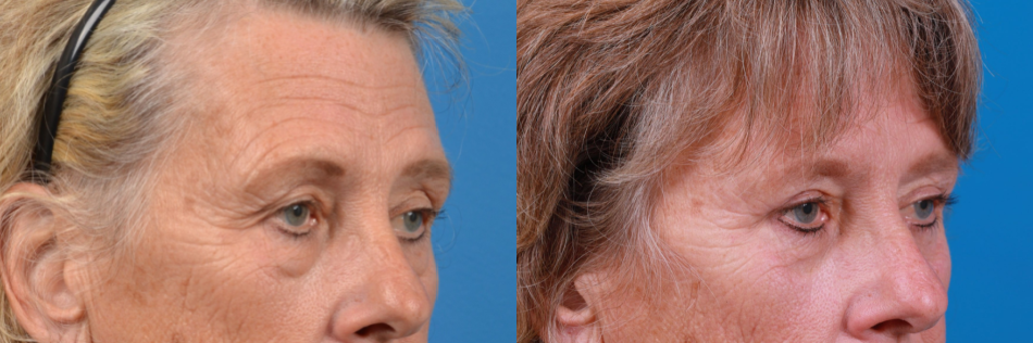 Eyelid Surgery Before & After Gallery - Patient 224476 - Image 3