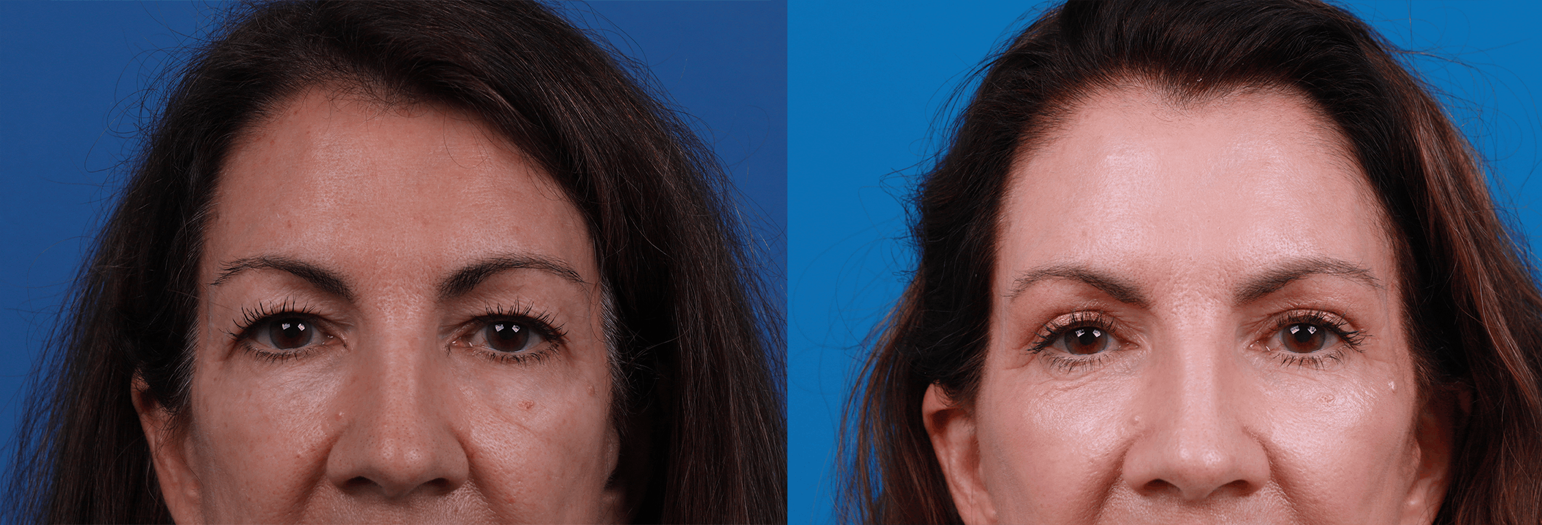 Eyelid Surgery Before & After Gallery - Patient 427149 - Image 1