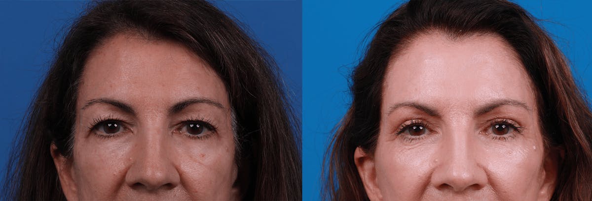 Eyelid Surgery Before & After Gallery - Patient 122444825 - Image 1