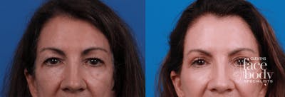 Eyelid Surgery Before & After Gallery - Patient 427149 - Image 1