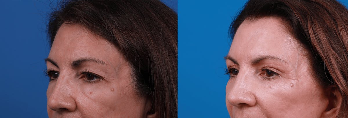 Eyelid Surgery Before & After Gallery - Patient 122444825 - Image 2