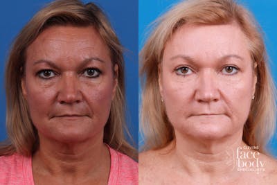 Eyelid Surgery Before & After Gallery - Patient 940392 - Image 1