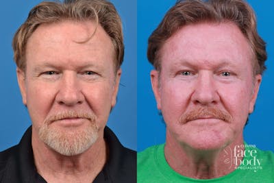 Eyelid Surgery Before & After Gallery - Patient 223920 - Image 1