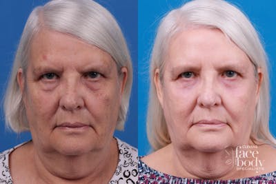 Eyelid Surgery Before & After Gallery - Patient 175092 - Image 1
