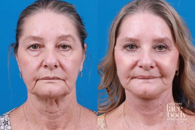 Eyelid Surgery Before & After Gallery - Patient 259418 - Image 1