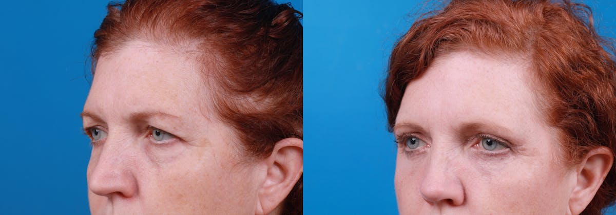Eyelid Surgery Before & After Gallery - Patient 122444861 - Image 1