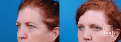 Eyelid Surgery Before & After Gallery - Patient 258971 - Image 1