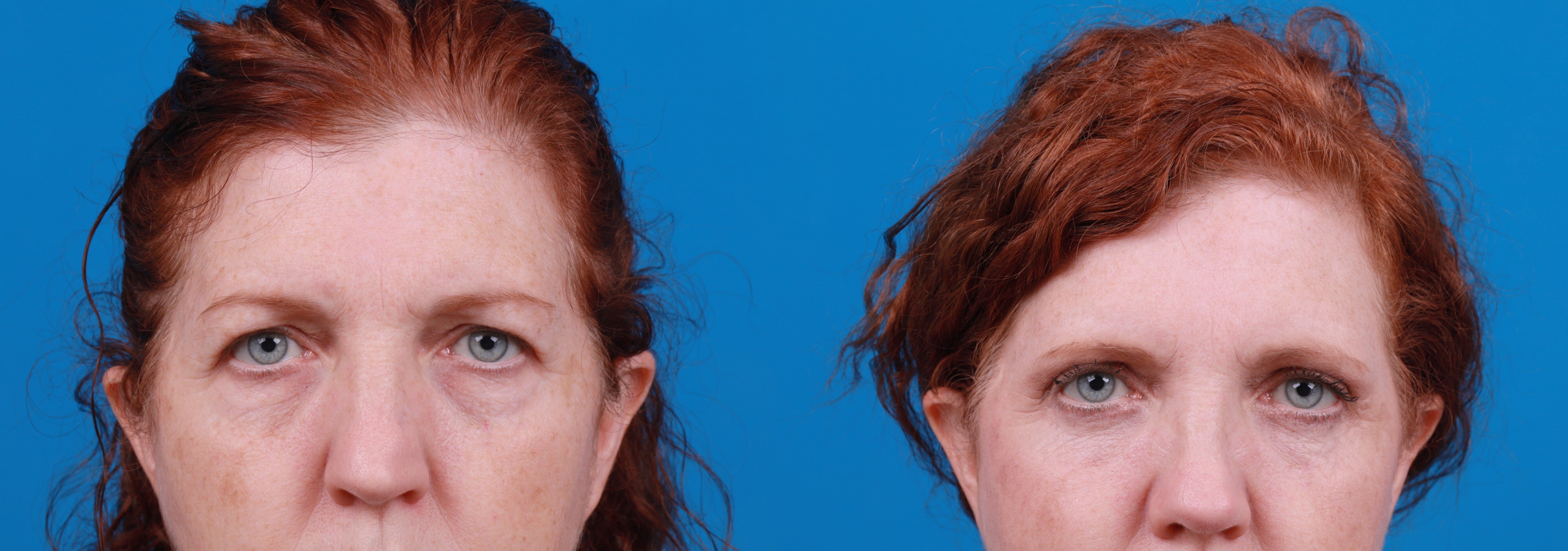 Eyelid Surgery Before & After Gallery - Patient 258971 - Image 2