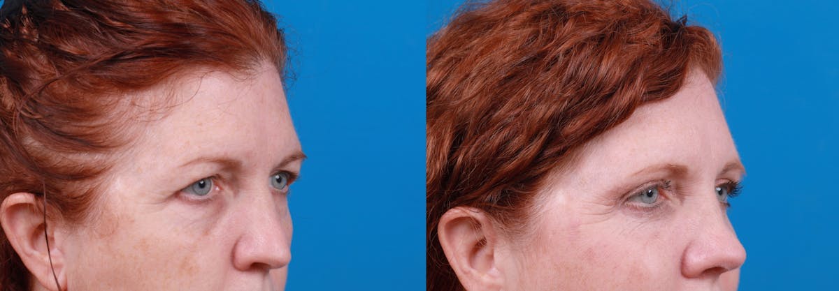 Eyelid Surgery Before & After Gallery - Patient 122444861 - Image 3