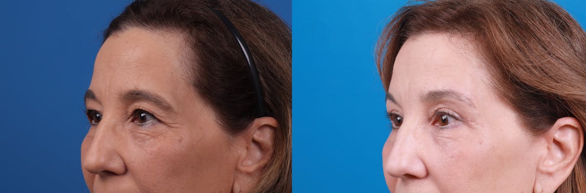 Eyelid Surgery Before & After Gallery - Patient 122444868 - Image 1